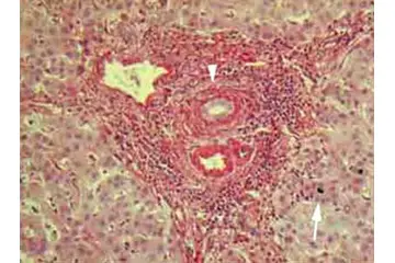 Otoimmün Hepatit Belirtileri ve Tedavisi